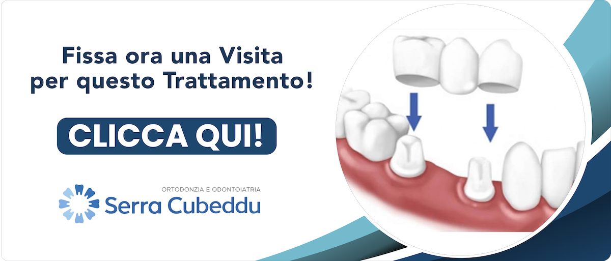 capsule-dentali-metal-free Sassari