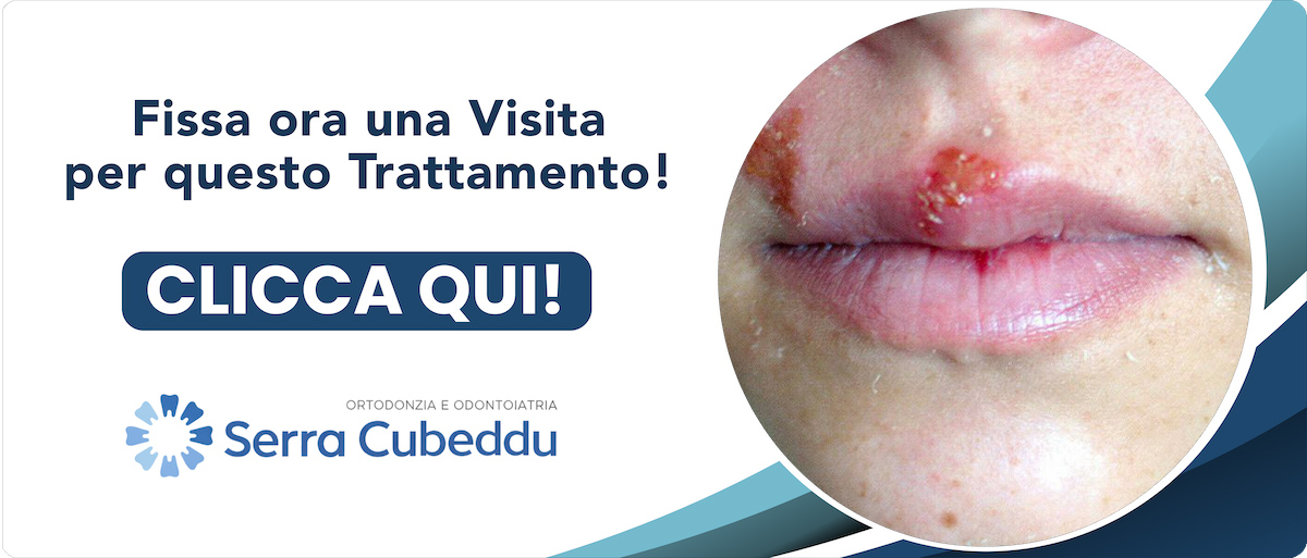cura-dell-herpes-labiale Sassari