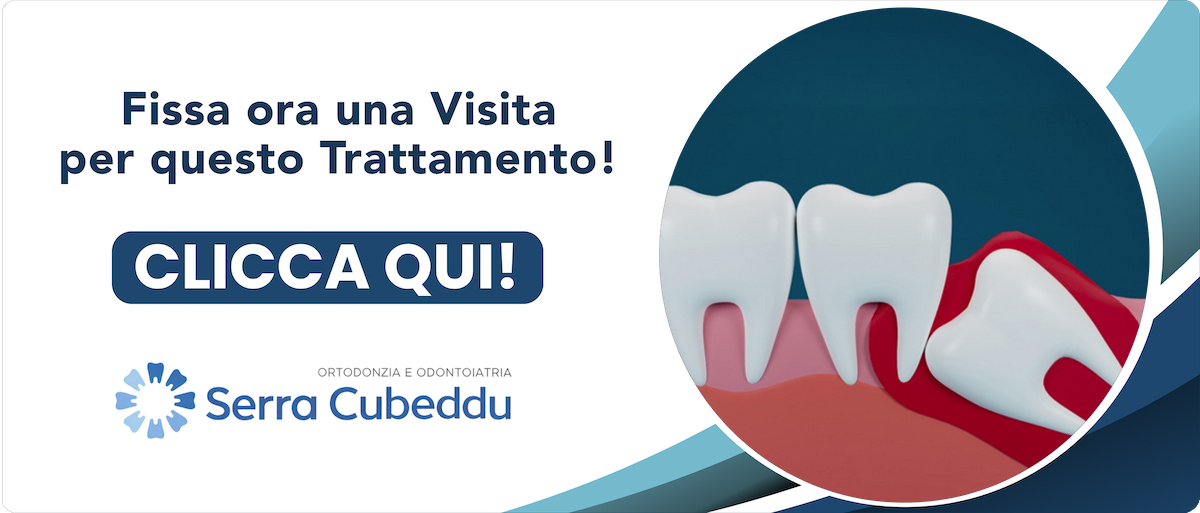 denti-canini-inclusi Sassari