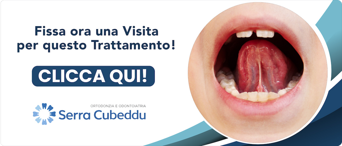 ortodonzia-frenulo-labiale-e-linguale Sassari