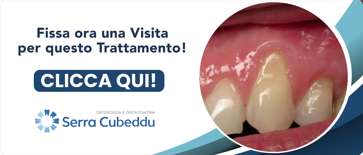 recessioni-gengivali Sassari